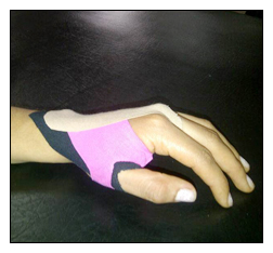 Fisioterapia de la mano en lima